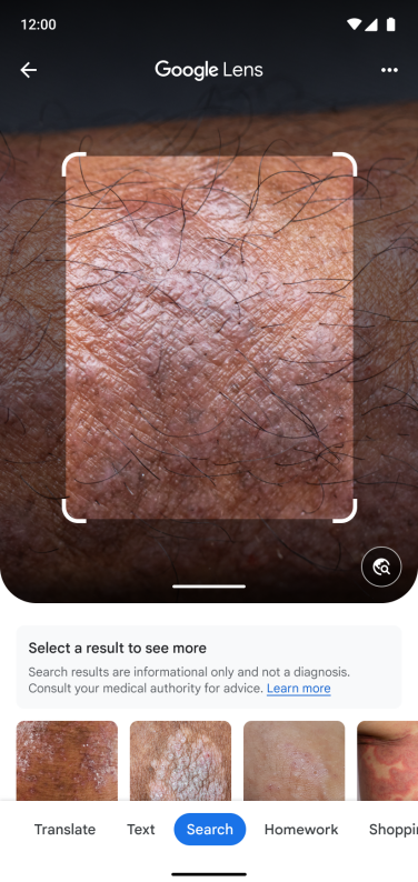 Image of Google Lens taking a photo of skin condition 