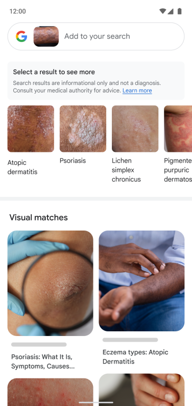 Google Lens searching for skin conditions that are visually similar to the photo taken.